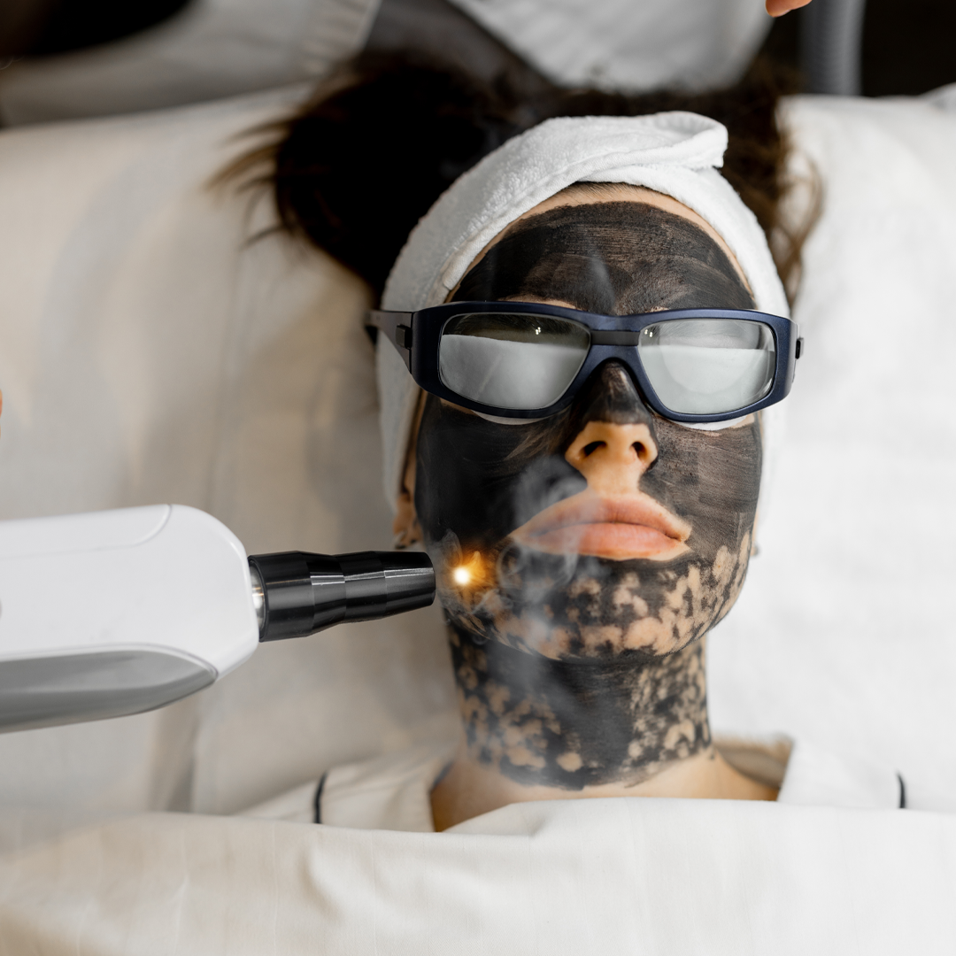 Carbon assisted Q switched laser treatment
