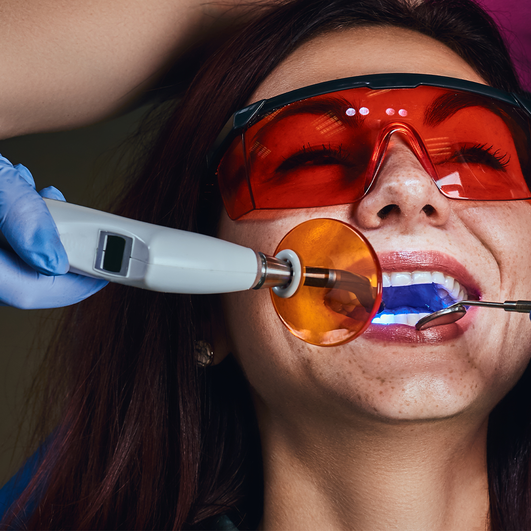 Composite Aesthetics Light Cure Fillings