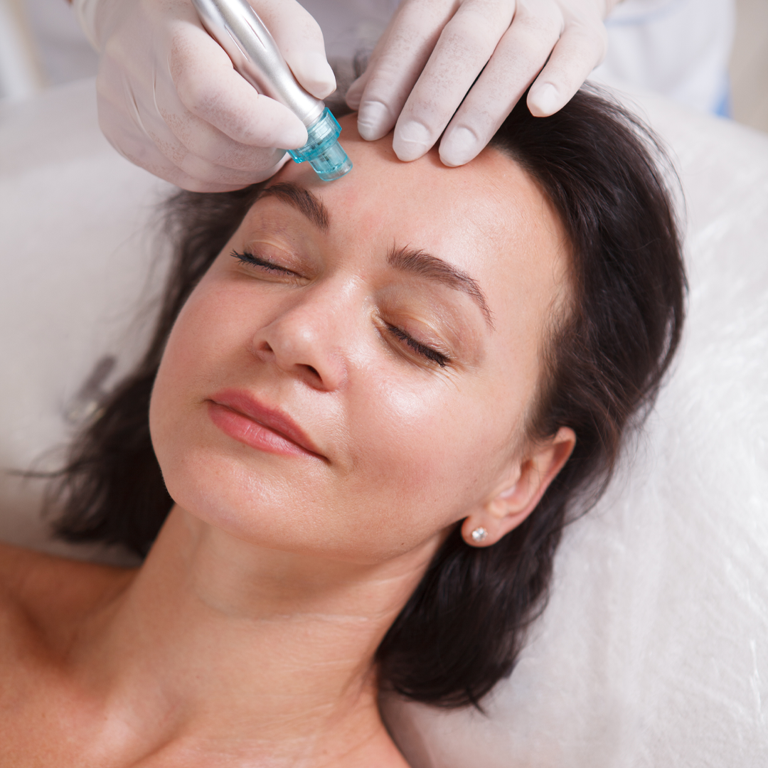 Exosomes with microneedling
