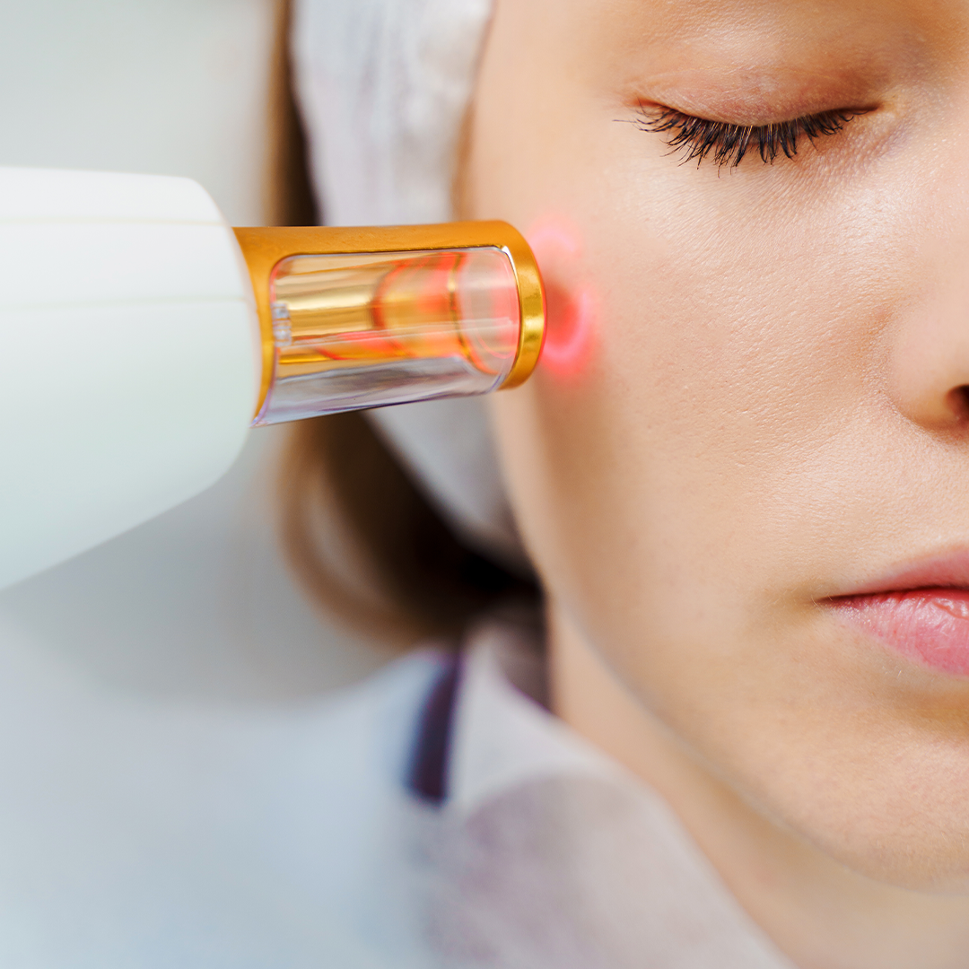 Laser Pigmentation and Melasma treatment