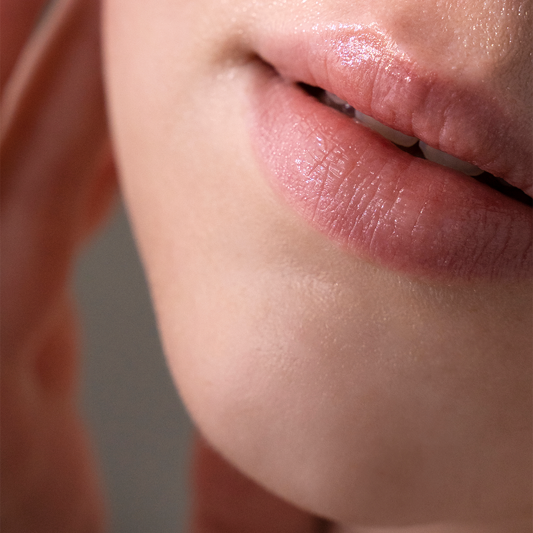 Natural lip augmentation with Cannula