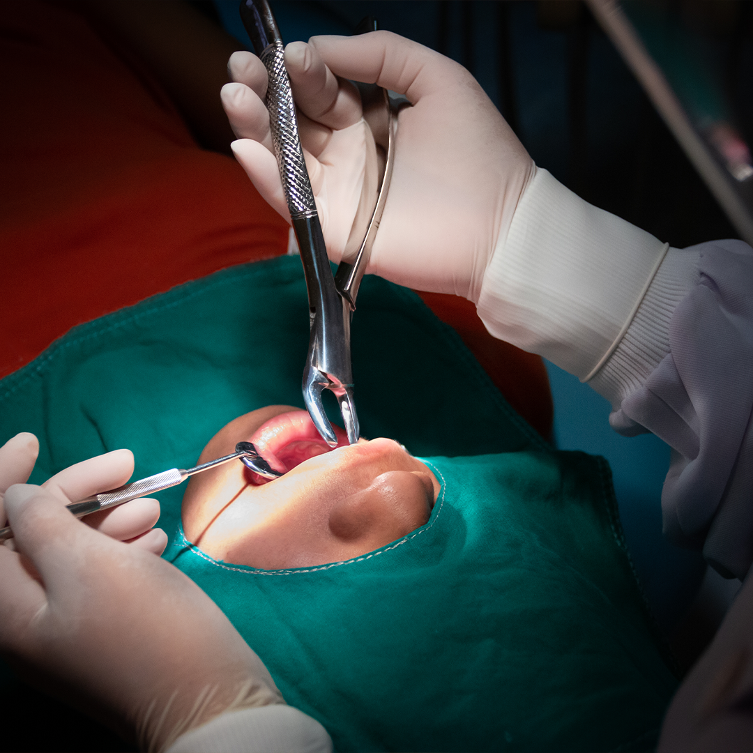 Surgical Extraction