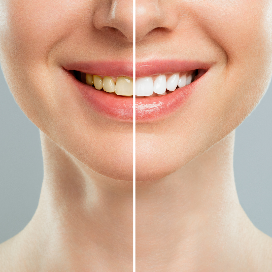 Nano Teeth Whitening